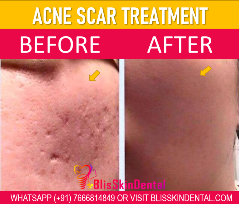 Acne Scar Treatment in Bandra, Mumbai at Bliss Skin Clinic