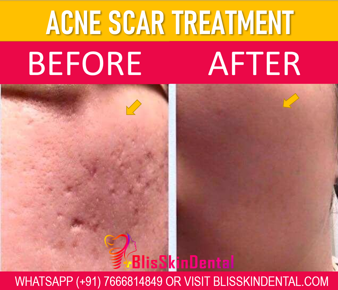 You are currently viewing Acne Scar Treatment in Bandra, Mumbai at Bliss Skin Clinic