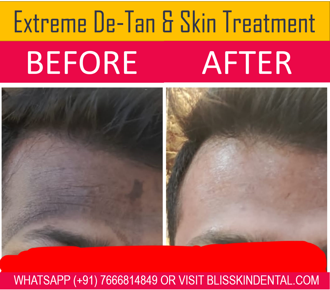 Read more about the article Skin Lightening and De-tanning Treatment at Bliss Skin Clinic in Bandra,Mumbai.