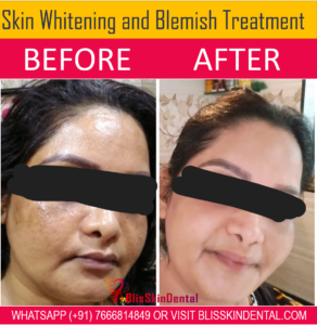 Read more about the article Skin Whitening Treatment in Bandra Mumbai