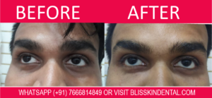 Read more about the article Undereye Darkcircle Treatment in Bandra, Mumbai