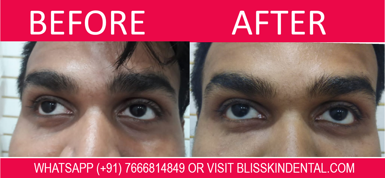 You are currently viewing Undereye Darkcircle Treatment in Bandra, Mumbai