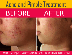 Read more about the article Get Clear and Glowing Skin with the Best Acne Treatment in Bandra, Mumbai.