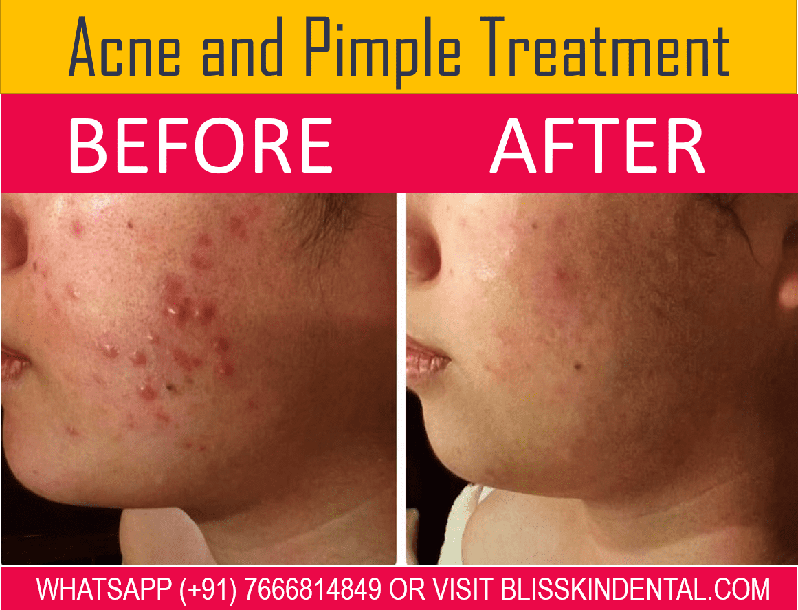 You are currently viewing Get Clear and Glowing Skin with the Best Acne Treatment in Bandra, Mumbai.