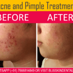 Acne And Pimple Treatment in Bandra,Mumbai