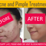 Acne Pimple Treatment in Bandra at Bliss Skin Clinic in Mumbai