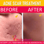 Acne Scar Treatment in Bandra, Mumbai