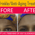 Anti Aging treatment for Forehead Wrinkle Removal in Bandra, Mumbai