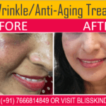 Facemark removal Treatment in Bandra, Mumbai at Bliss Skin Clinic