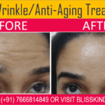 Forehead Wrinkle Removal in Bandra, Mumbai at Bliss Skin Clinic