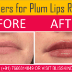 Lip Augmentation Treatment in Bandra, Mumbai