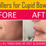 Lip Filler Treatment for Cupid Bow Lips in Bandra,Mumbai