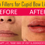 Lip Fillers Treatment Cost in Bandra,Mumbai