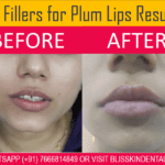 Lip Fillers Treatment for Plum Lips in Bandra,Mumbai
