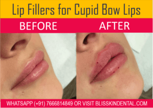 Read more about the article Enhance Your Beauty – Get Fuller Lips with Lip Filler in Bandra,Mumbai
