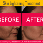 Skin Lightening Treatment at Bliss Skin Clinic in Bandra