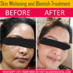 Skin Whitening and Face Marks Removal Treatment in Bandra,Mumbai