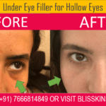 Undereye Dark Circle Removal Trwatment with Fillers in Bandra at Bliss Skin Clinic