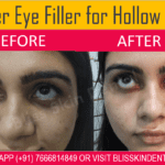 Undereye Dark Filler Treatment in Bandra by Dr Afsha of Bliss Skin and Dental Clinic