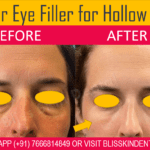 Undereye Darkcircle Removal Treatment at Bliss Skin Clinic in Mumbai