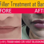 Lip Filler Treatment at Bandra at Bliss Skin Clinic