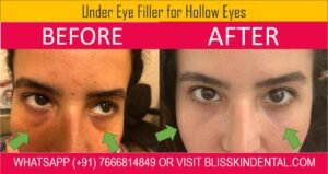 Read more about the article DARK CIRCLES UNDER EYES TREATMENT IN BANDRA