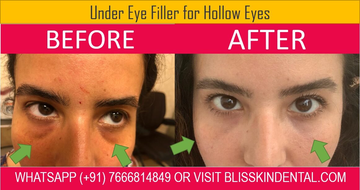 You are currently viewing DARK CIRCLES UNDER EYES TREATMENT IN BANDRA