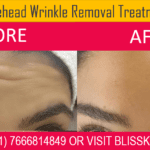 Forehead Wrinkle Removal Treatment in Bandra Mumbai at Bliss Skin Clinic