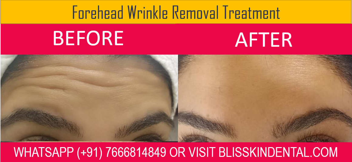 Read more about the article Forehead Wrinkle Removal Treatment in Bandra, Mumbai