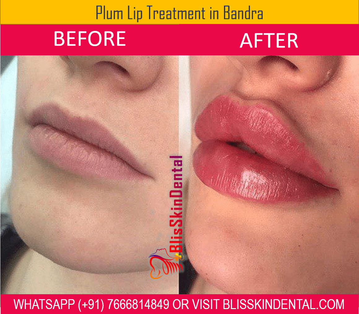 Read more about the article Lip contouring treatment in Mumbai at Bliss Skin Clinic Bandra.