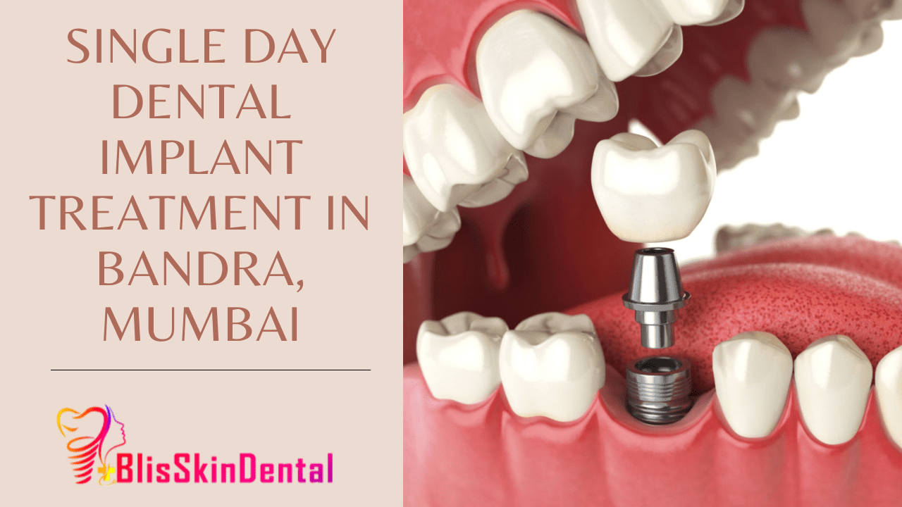 Read more about the article Single Day Dental Implant Treatment in Bandra,Mumbai