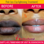 Get Pink Lips with Lip lightening therapy in Bandra, Mumbai