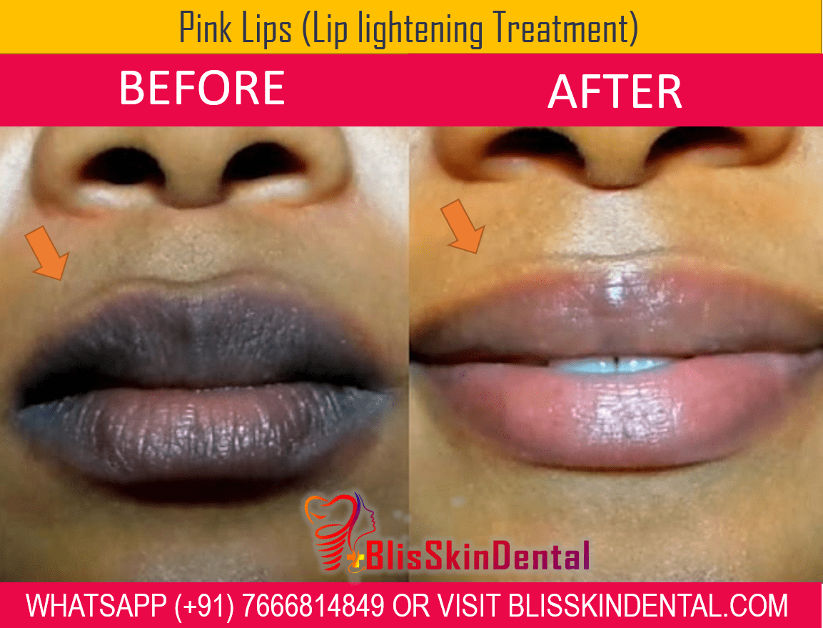 You are currently viewing Get Pink Lips with Lip lightening therapy in Bandra, Mumbai