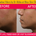 Jawline Fillers by Dr Afsha Haji at Bliss Skin Clinic in Bandra
