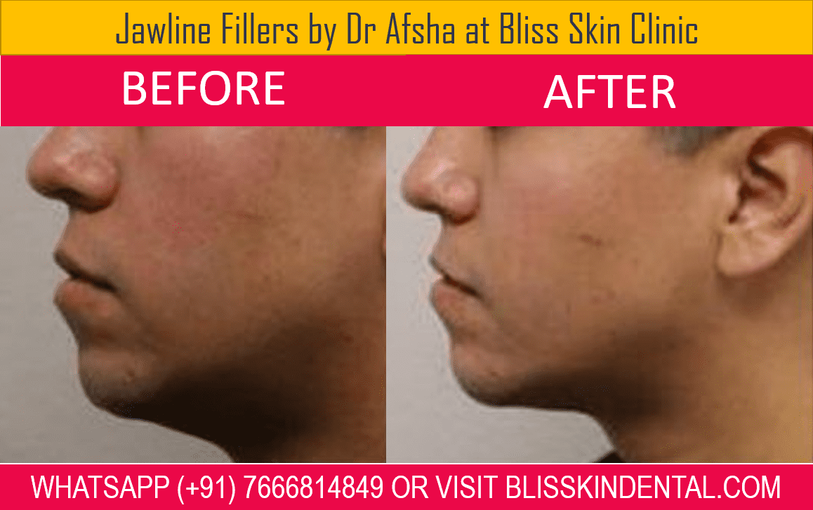 You are currently viewing Jawline Fillers by Dr. Afsha Haji at Bliss Skin Clinic in Bandra