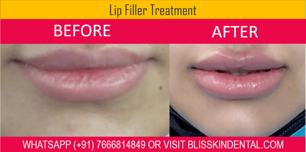 Transform Your Appearance with Dermal Fillers in Bandra, Mumbai
