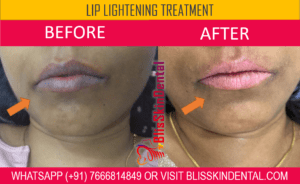 Read more about the article Lip Lightening Treatment in Mumbai