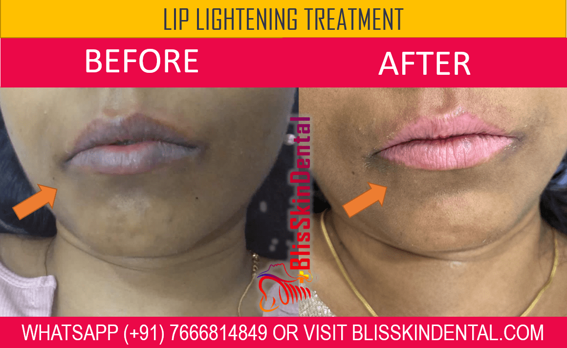 You are currently viewing Lip Lightening Treatment in Mumbai