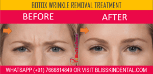 Read more about the article BOTOX Wrinkle Removal treatment in Bandra,Mumbai