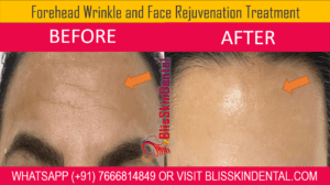 Read more about the article Dr. Afsha Haji Provides Anti-Wrinkle Treatment in Bandra, Mumbai