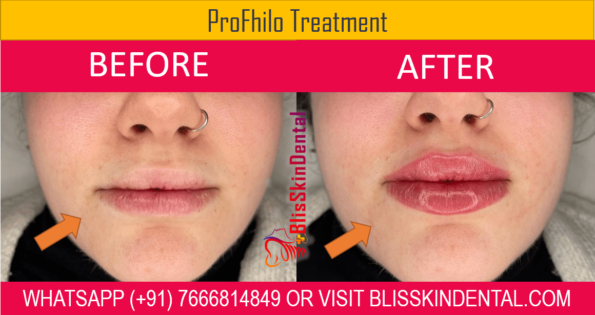 Read more about the article Natural Lip Contouring treatment in Bandra at Bliss Skin Clinic