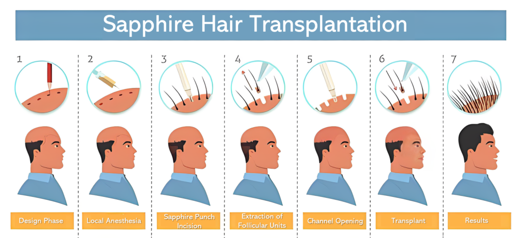 Sapphire Hair Transplantation in Bandra, Mumbai
