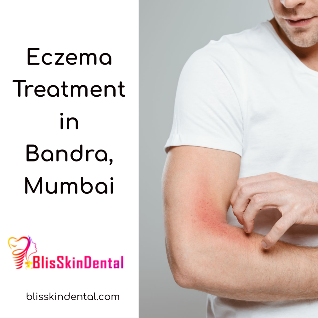 Eczema treatment in Bandra, Mumbai