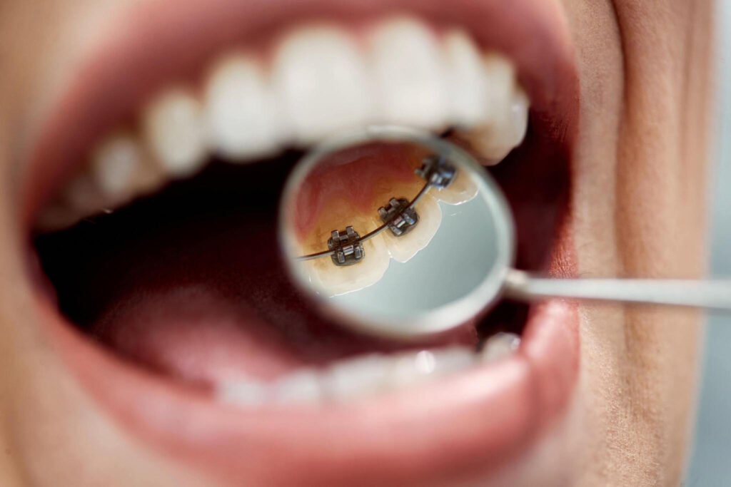 Dental Braces in Bandra - Bliss Dental Clinic