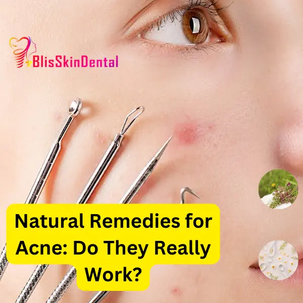 Natural Remedies for Acne: Do They Really Work?