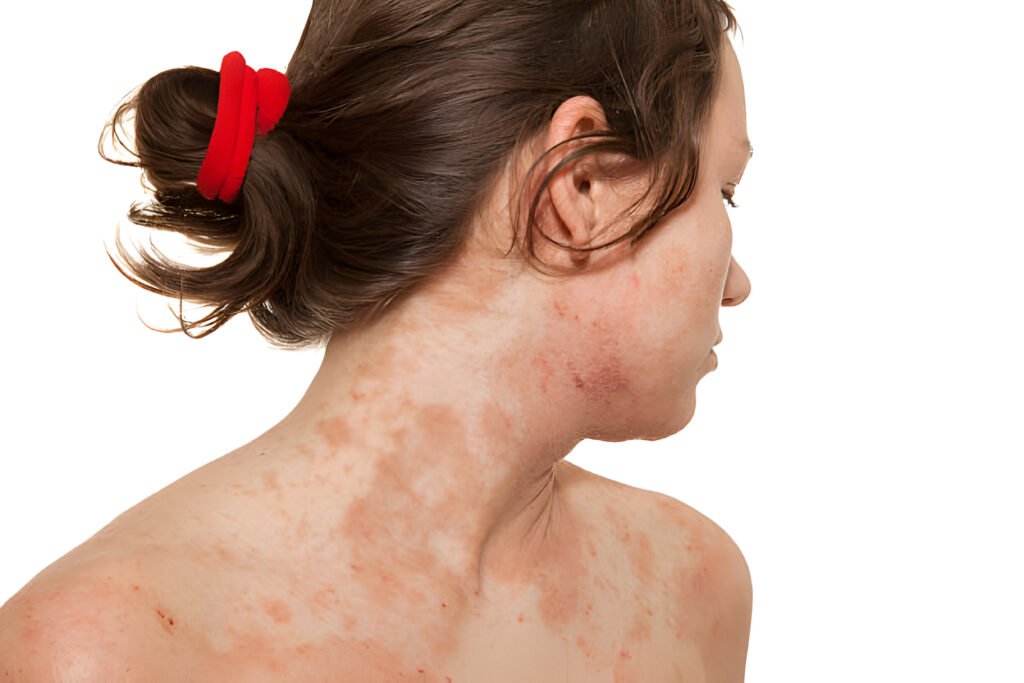 Eczema Treatment in Bandra | Bliss Skin and Dental Clinic