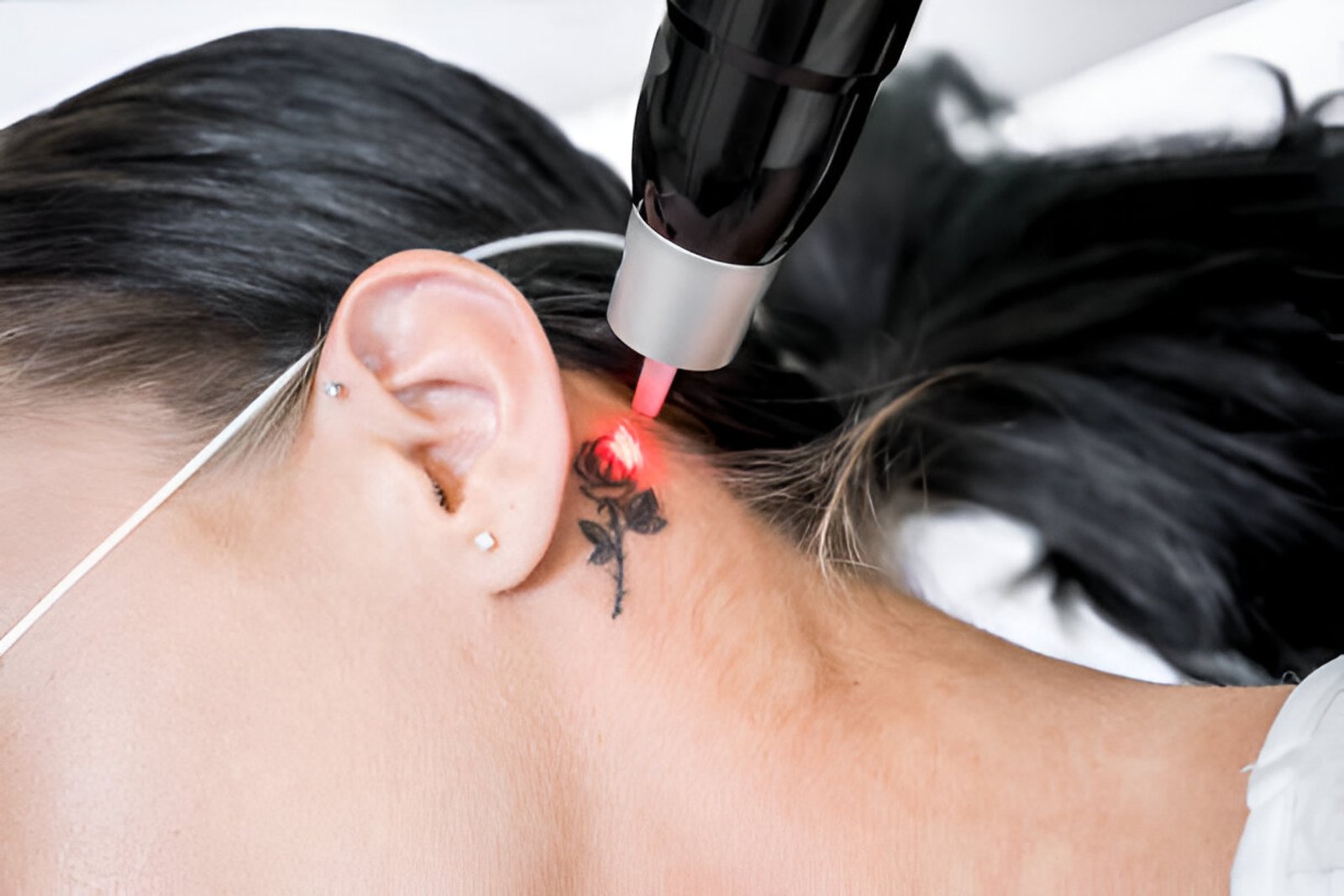 Laser tattoo removal procedure at Bliss Skin and Dental Clinic in Bandra