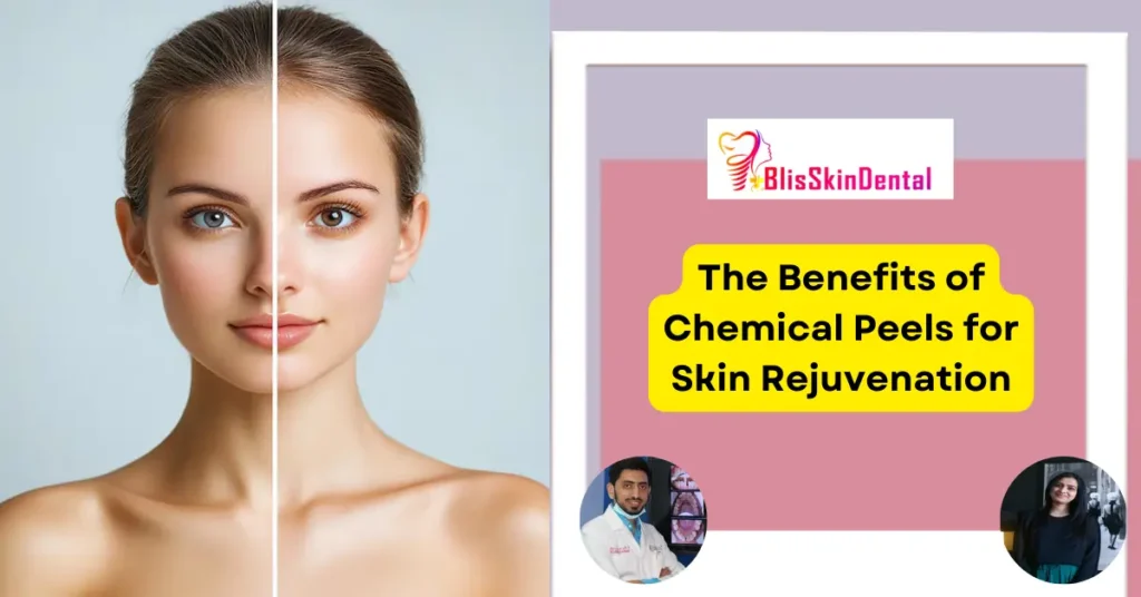 The Benefits of Chemical Peels for Skin Rejuvenation