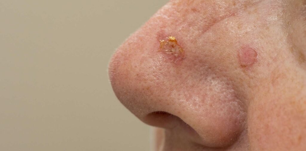 Image of actinic keratosis patches on skin.